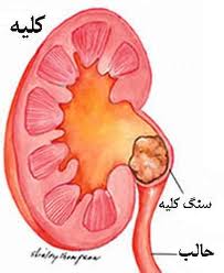 افراد مضطرب و مشوش با خطر بیماری سنگ سازی گُرده مواجه هستند