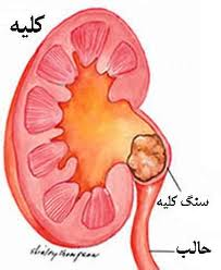 شیوه جالب درمان سرطان گُرده