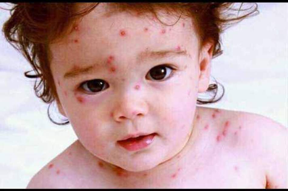 Nearly four thousand children have been infected with measles in Badakhshan