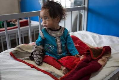 سوء التغذية يهدد حياة ملايين الأطفال في أفغانستان