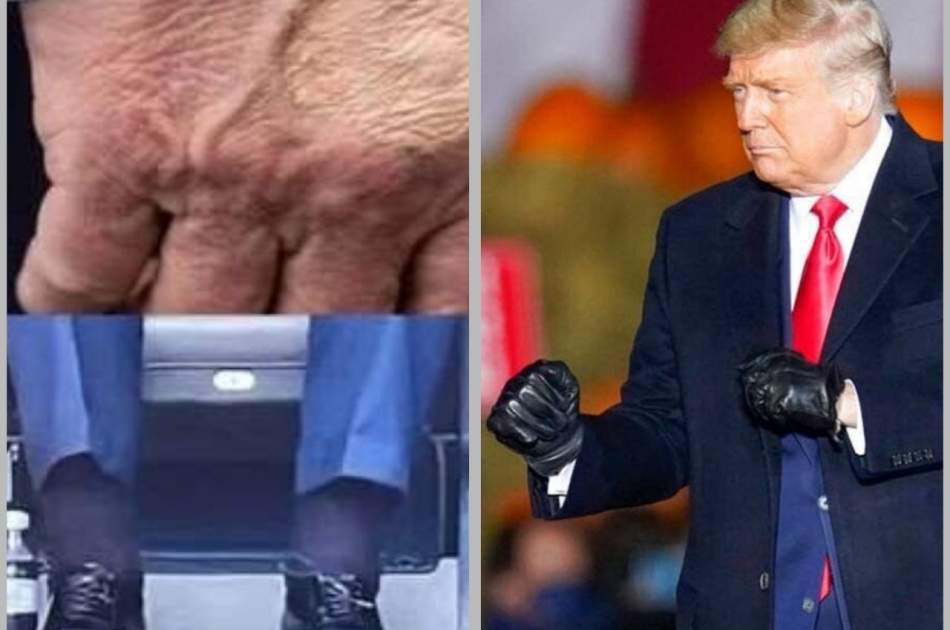 Donald Trump Suffers from Venous Insufficiency; Is the US President
