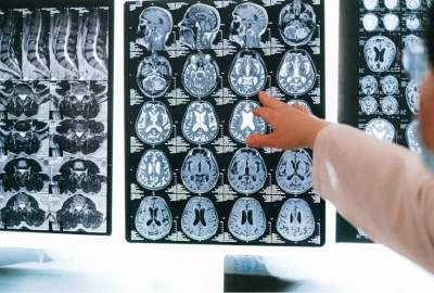 شركة نيورالينك التابعة لإيلون ماسك تُعلن عن توسع تجاربها للشرائح الدماغية البشرية