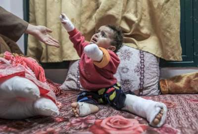 غزة تسجل أعلى معدل عالمي لبتر أطراف الأطفال